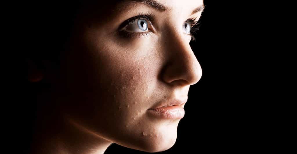 Traitement de l’acné : les traitements médicamenteux locaux