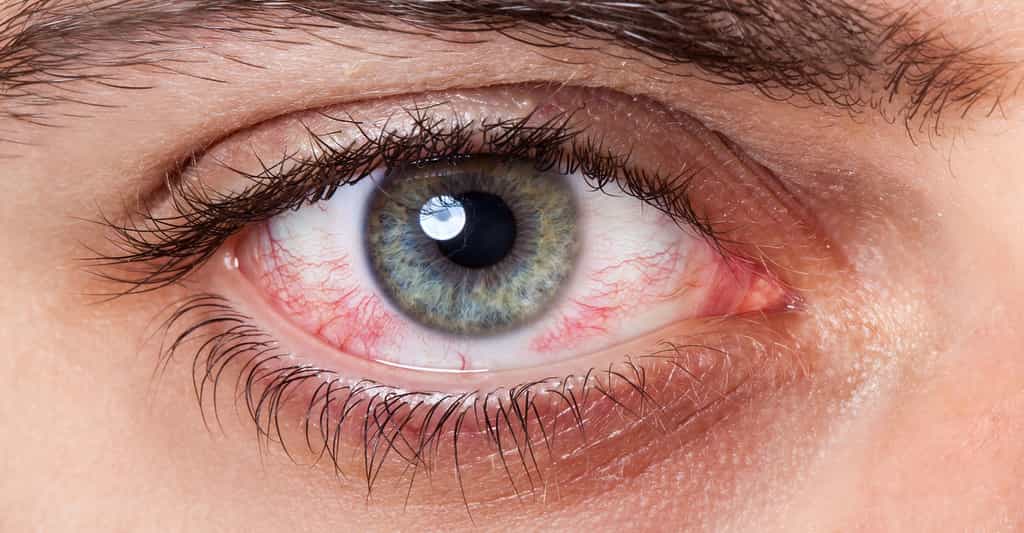 Pathologies de l'œil : du glaucome à l'onchocercose