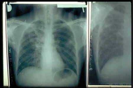 Diagnostic de la tuberculose