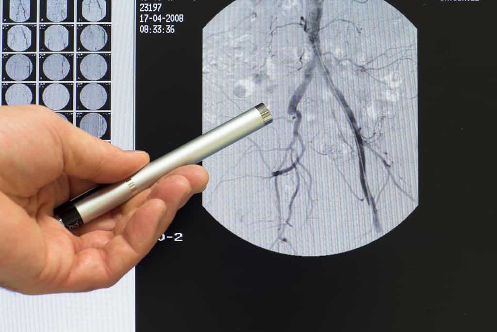 L’angiographie est réalisée par un radiologue. © Bergringfoto/Fotolia