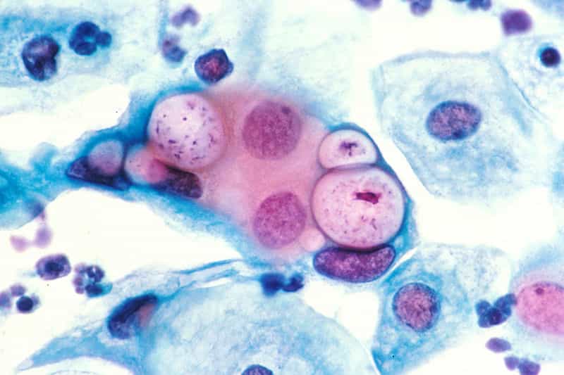 Chlamydia trachomatis est la bactérie responsable de la chlamydiose. © Lance Liotta Laboratory