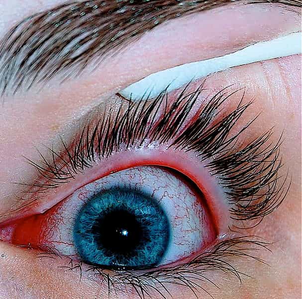 La conjonctivite allergique occasionne surtout des yeux rouges, associés à un sentiment d'irritation.&nbsp;© Joyhill09, Wikipédia, cc by sa 3.0