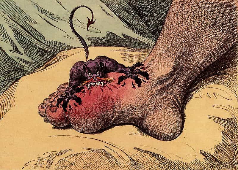 La goutte est une maladie douloureuse, souvent développée au niveau du gros orteil. © DR