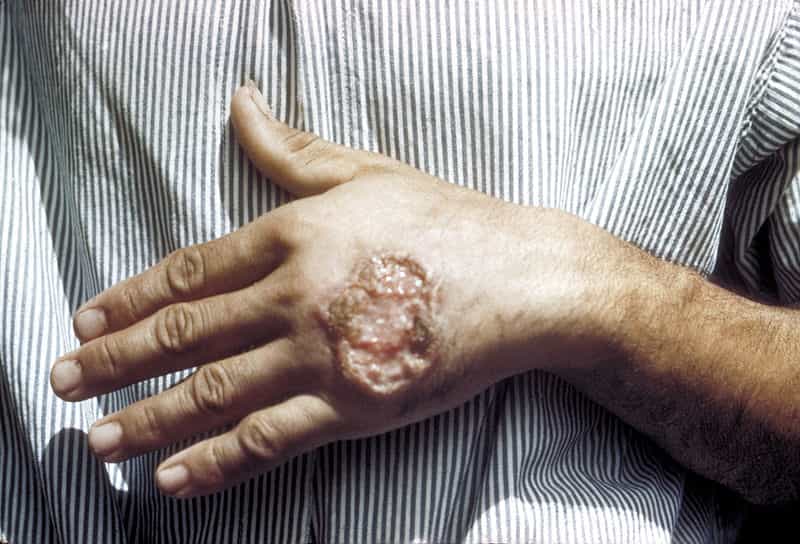 Leishmaniose cutanée de la main. © CDC, DP
