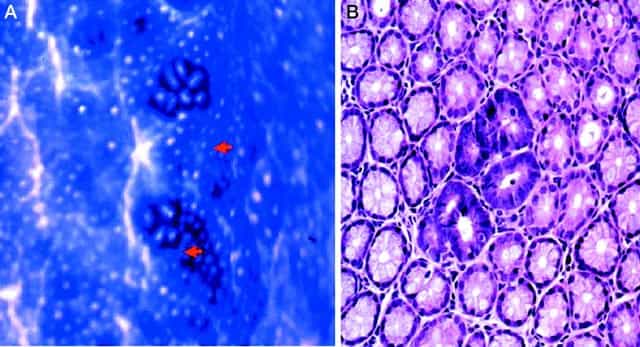 Des lésions prénéoplasiques sur l'épithélium intestinal sont visibles sur l'image de gauche (flèches rouges) et sur celle de droite (violet plus foncé). © Nature