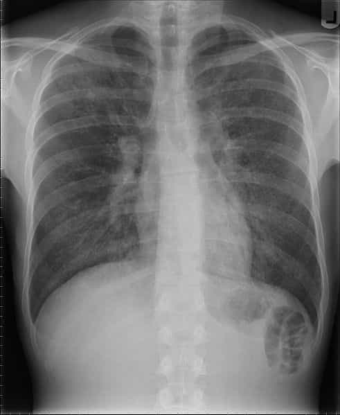 La pneumonie peut être liée à une infection par Pneumocystis jiroveci, visible ici sur une radiographie des poumons. © Samir, Wikimedia, CC by-sa 3.0