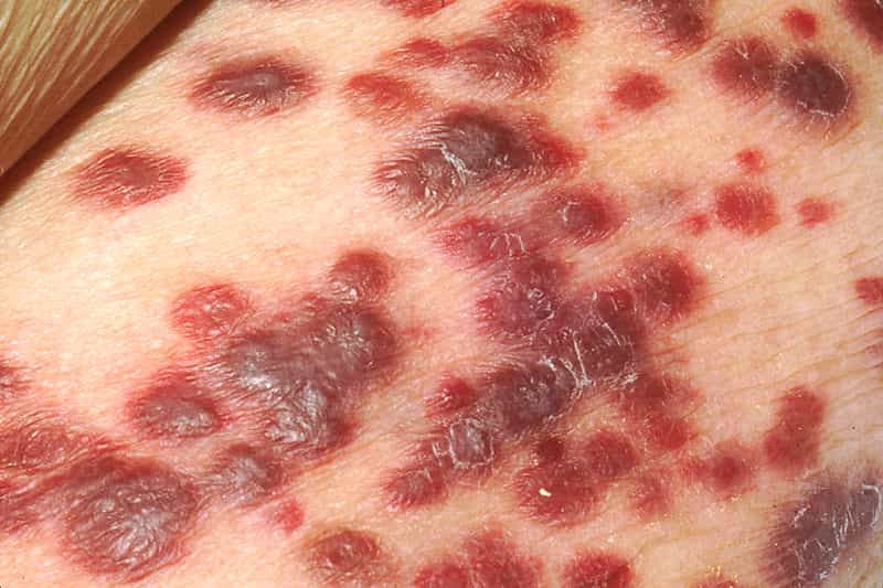 Le sarcome de Kaposi se développe particulièrement chez les personnes immunodéprimées. Son incidence a explosé avec l'épidémie de VIH. © National Cancer Institute, Wikimedia Commons, DP