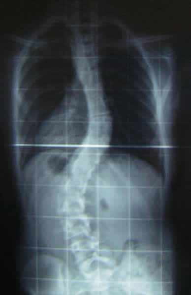 La scoliose est une déformation, parfois impressionnante, de la colonne vertébrale. © Silverjonny, Wikimedia, DP