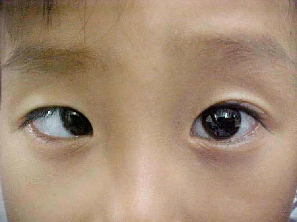 Le strabisme, avec cet exemple d'ésotropie, touche principalement les enfants et doit être corrigé le plus tôt possible pour éviter au maximum les problèmes d'acuité visuelle. © Community Eye Health, Flickr, cc by nc 2.0