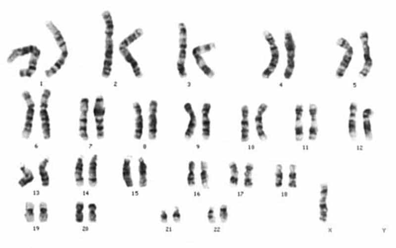 Le syndrome de Turner est caractérisé par une monosomie du chromosome X. © Wikimedia, CC by-sa 3.0
