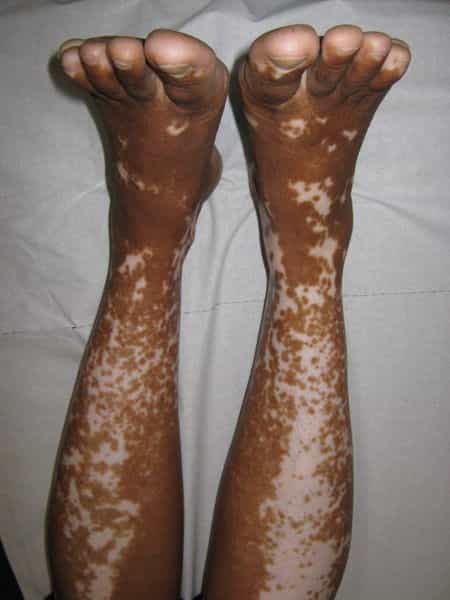 La décoloration de la peau à cause du vitiligo peut affecter des surfaces corporelles plus ou moins importantes. © Grook Da Oger, Wikipédia