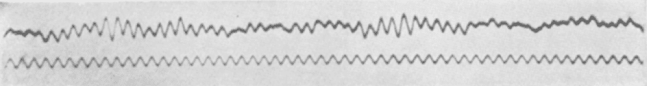 

Le premier EEG, tel qu'il a été enregistré par Hans Berger publié en 1929. © Domenico Forastiere, Wikimedia