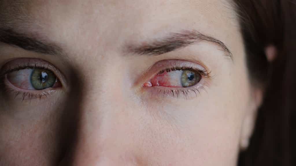 La conjonctivite peut être d’origine allergique, virale bactérienne ou irritative. © domaskina, Fotolia