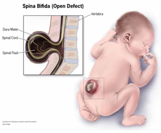 Le spina bifida est une malformation située au niveau de la moelle épinière et des vertèbres qui l'entourent. © CDC