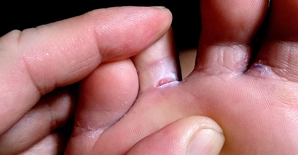 Symptômes et traitements de la mycose des pieds. © ProjectManhattan,&nbsp;Wikimedia commons, CC by-sa&nbsp;3.0