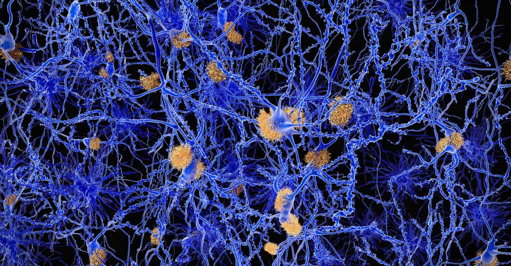 Dans la maladie d'Alzheimer, des plaques amyloïdes (ici en orange) s'accumulent entre les neurones (en bleu) et sont liées à l’agrégation de protéines mal repliées. Le phénomène est tout à fait similaire dans les maladies à prions. © Juan Gaertner, Shutterstock