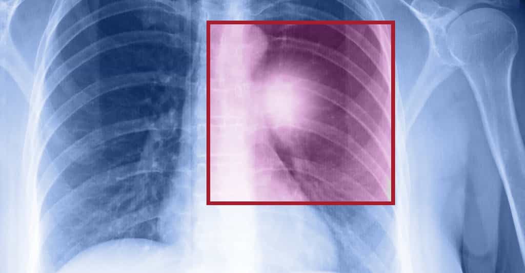 Le cancer du poumon peut être détecté par une radiographie, un scanner thoracique et une biopsie. © muratart, Shutterstock