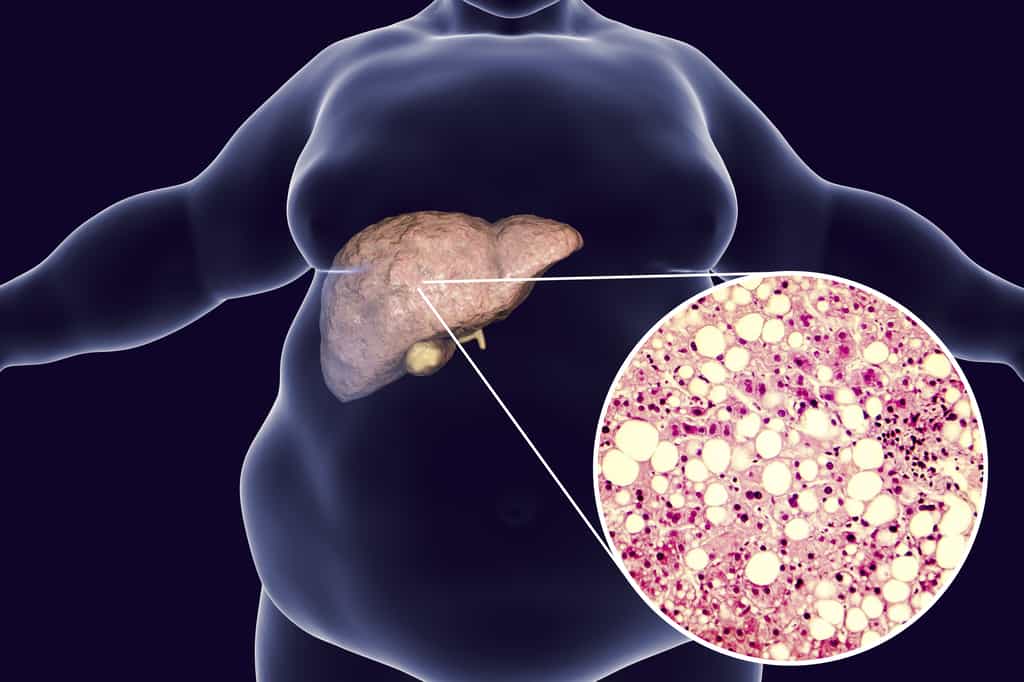 Stéatose du foie chez un homme obèse © Kateryna_Kan, Adobe Stock