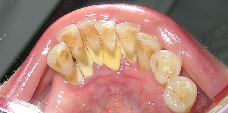 Le détartrage consiste à retirer le tartre qui s’est accumulé sur les dents, comme à la base des dents de cette mâchoire. © DRosenbach, Wikipédia, DP