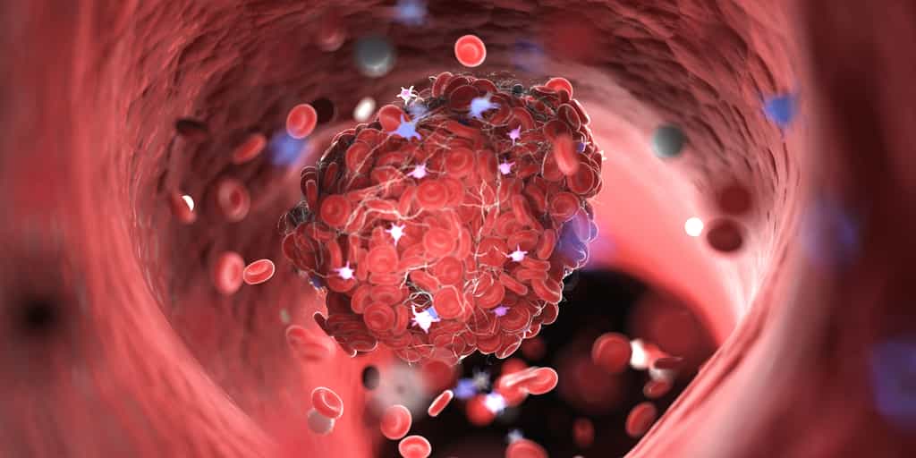 La thrombocytémie essentielle est une maladie chronique et incurable qui engendre une production anormale de plaquettes dans le sang. © Sebastian Kaulitzki, Adobe Stock