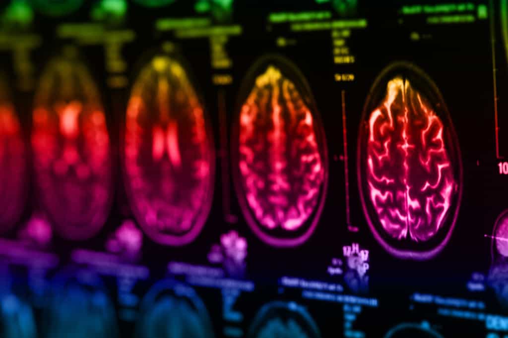 Les gliomes sont les tumeurs cérébrales les plus fréquentes. © merydolla, Fotolia