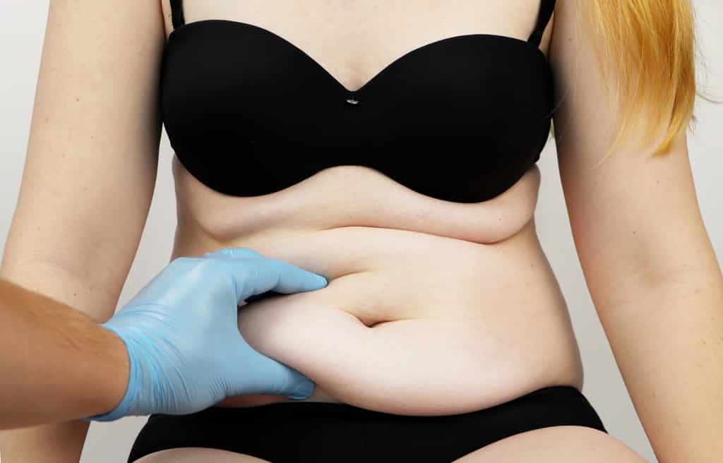 L'abdominoplastie est une procédure de chirurgie esthétique ou réparatrice de l'abdomen qui s'apparente à un lifting du ventre. © Siniehina, Adobe Stock