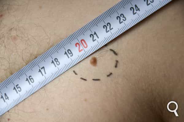 Les mélanomes se caractérisent par le développement excessif des mélanocytes, les cellules responsables de la coloration de la peau. Ces tumeurs peuvent progresser rapidement et contaminer d’autres régions du corps sous forme de métastases. Le rose bengale, en activant la réponse immunitaire, détruit les cellules cancéreuses. Est-ce là une solution contre ce type de cancer ? © Fotolia
