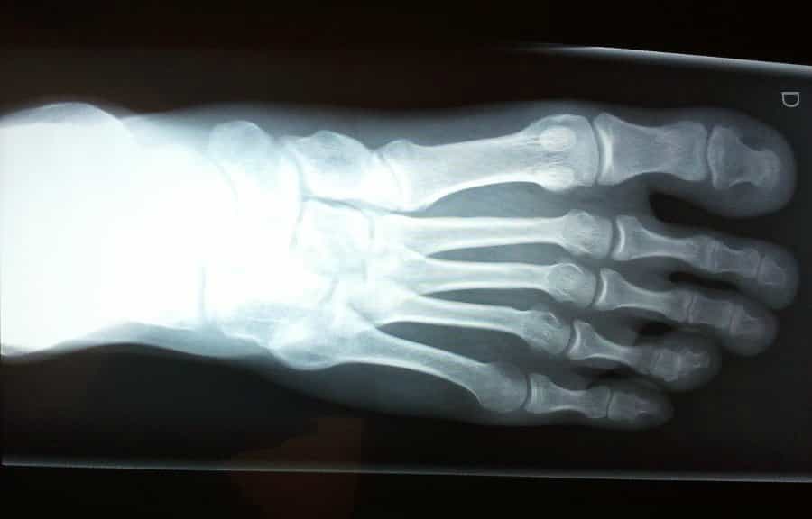 La malformation du pied creux est le plus souvent diagnostiquée à l’adolescence. ©Phovoir