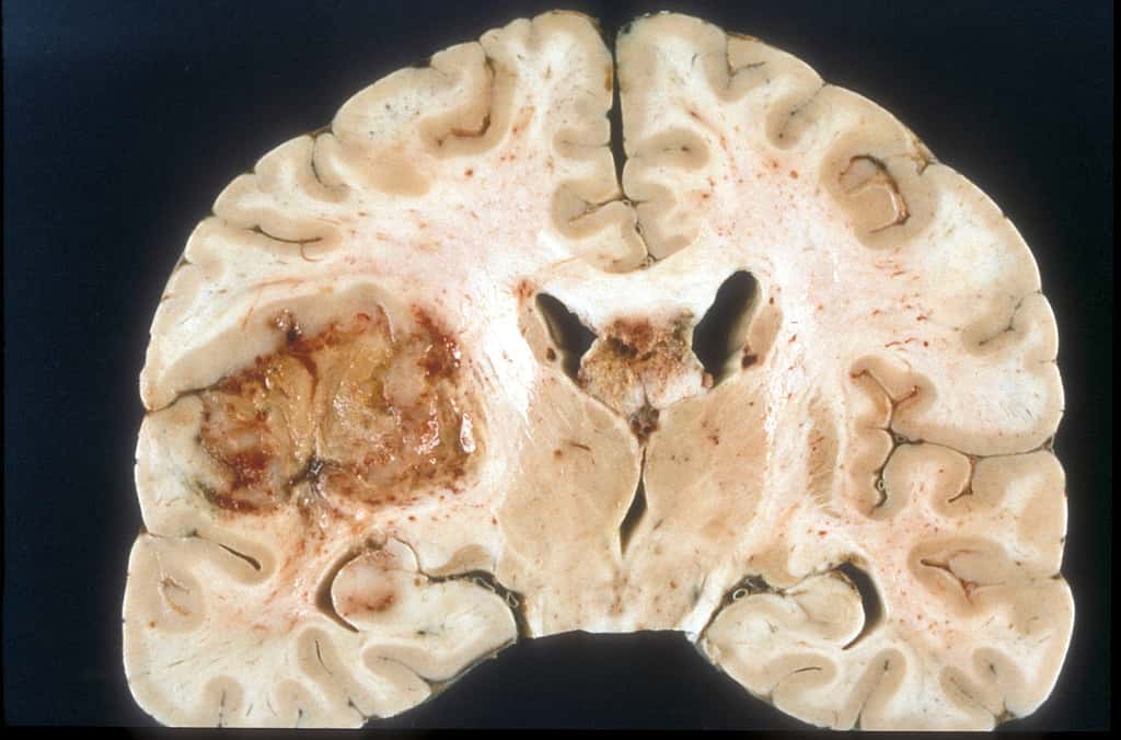 Coupe d'un cerveau atteint de glioblastome multiforme © <em>Wikimedia Commons</em>, Sbrandner 
