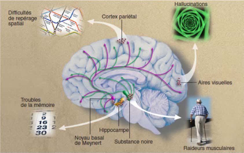 La maladie des corps de Lewy détruit en priorité les neurones de la substance noire et du noyau basal de Meynert. La substance noire irrigue les circuits moteurs du cerveau en dopamine (flèches vertes) ; le noyau basal de Meynert fournit de l’acétylcholine (flèches roses) à l’hippocampe (plaque tournante de la mémoire) et au néocortex qui assure l’ensemble des fonctions cognitives. Quand les corps de Lewy (points rouges) sont localisés dans l’hippocampe, ils provoquent des troubles de la mémoire ; situés dans les zones pariétales, ils entraînent des difficultés de repérage spatial, et dans les aires visuelles, des hallucinations. Localisés dans la substance noire, ils sont responsables de raideurs musculaires. © Shutterstock,<em> Cerveau & Psycho</em>