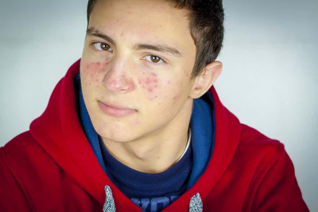 Les adolescents souffrant de problèmes d’acné sont plus susceptibles de surinvestir leurs études. © hriana, Fotolia