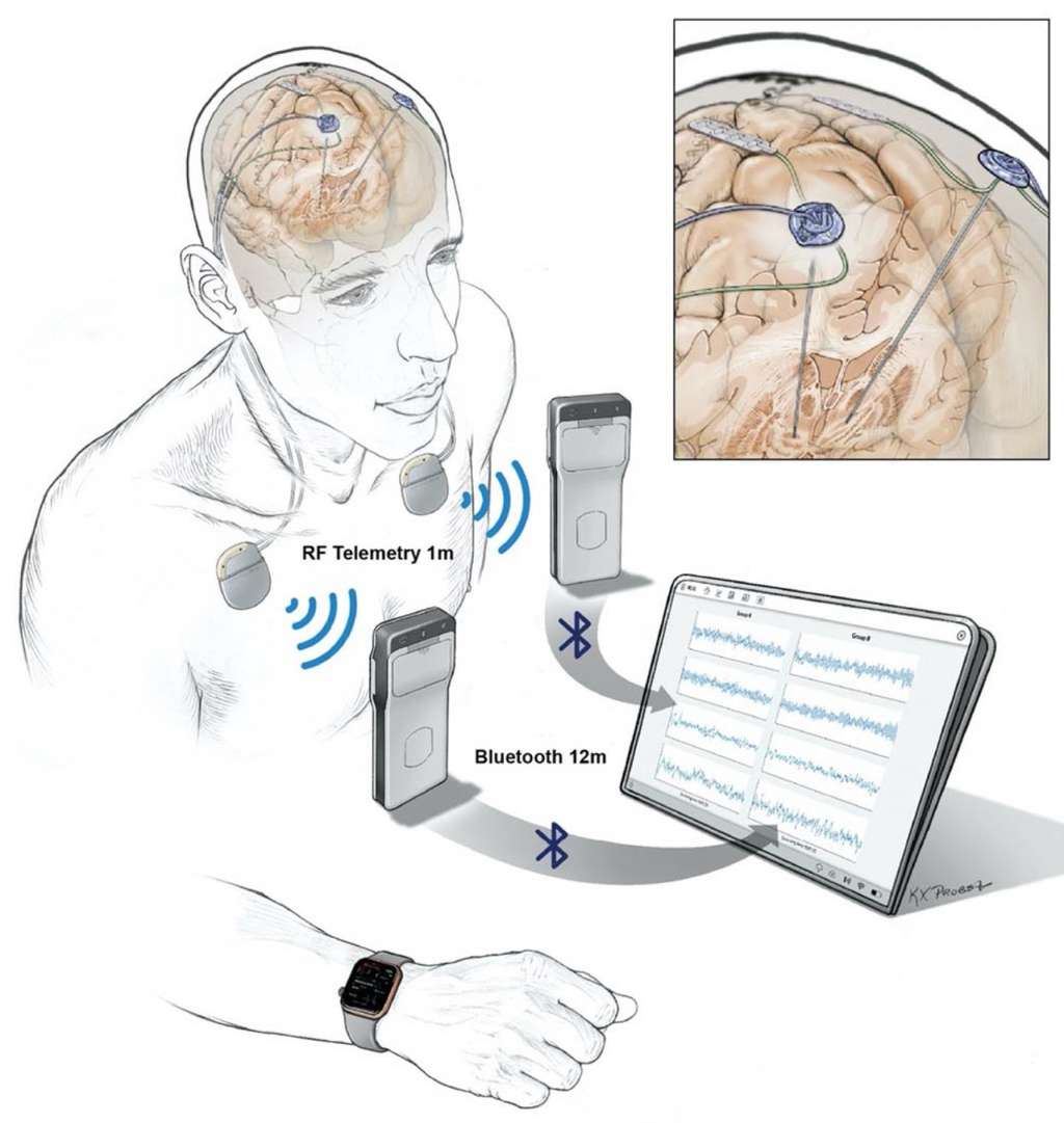 Des électrodes implantées dans le cerveau transmettent des données enregistrées à un dispositif de poche porté par un patient. Les données sont ensuite transférées sans fil sur une tablette, puis téléchargées vers le cloud <em>via</em> un serveur conforme HIPAA. © <em>Courtesy of Starr lab,</em> UCSF