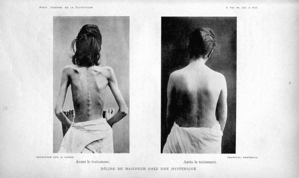 Photo d'une patiente souffrant d'anorexie mentale en 1894. © <i>Nouvelle Iconographie de la Salpêtrière, </i>Galica bnf,<i> </i>p. 328