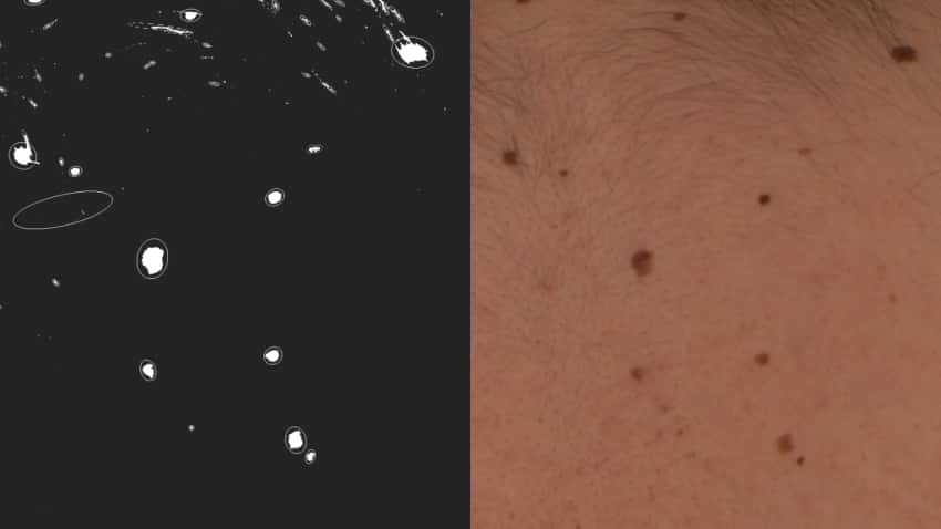 À droite, des grains de beauté sur le dos d'un patient ; à gauche, les mêmes grains de beauté en tant que cibles en forme d'étoile dans le logiciel astronomique utilisé par l'équipe de MoleGazer. © L'équipe de MoleGazer.