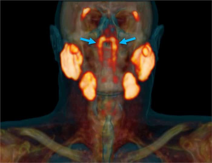 Un aperçu des glandes tubariales, visualisées avec le PSMA PET-scan. © Vastal et <em>al.</em>