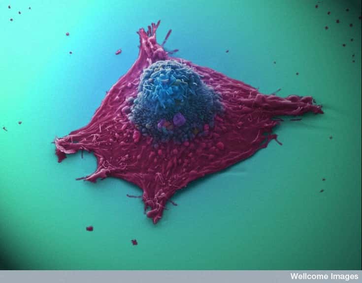 Les cellules cancéreuses peuvent échapper au système immunitaire et se développer. En augmentant l'activité du système immunitaire, il est cependant possible de mieux les combattre. © Anne Weston, Wellcome image, cc by nc nd 2.0