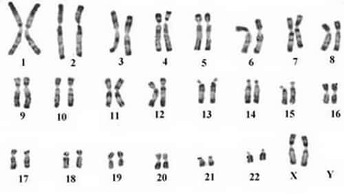 L’ovotestis correspond à un organe génital possédant à la fois les propriétés des gonades masculines et féminines. Un caryotype permet de déterminer le sexe génétique de l'enfant. ©Phovoir