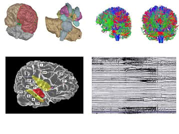 Le Patient Epileptique Virtuel : les régions du cerveau et leurs connexions sont reconstruites par ordinateur. Les simulations numériques génèrent un signal électrique similaire à celui généré par le cerveau pendant les crises. Ces simulations permettent de tester informatiquement de nouvelles stratégies thérapeutiques. © INS UMR1106 Inserm, AMU