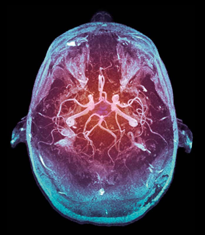 Le cercle artériel du cerveau, ou polygone de Willis, est un réseau d'artères présent dans le cerveau qui assure l'approvisionnement en nutriments et en oxygène aux neurones. © Victor Brezinsky, Flickr, cc by sa 2.0