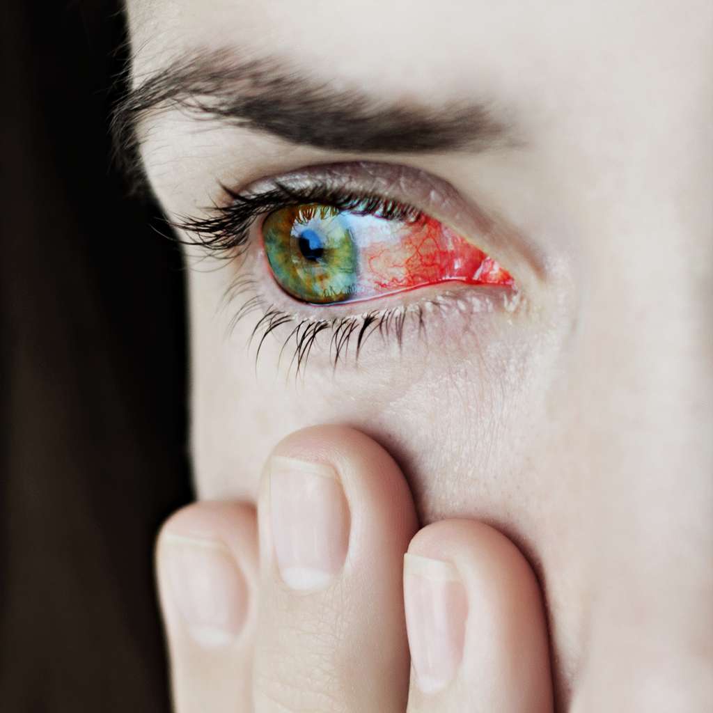 La maladie de Behçet peut toucher les yeux. Cette atteinte oculaire est grave, elle peut entraîner la cécité. © Domaskina, Adobe Stock