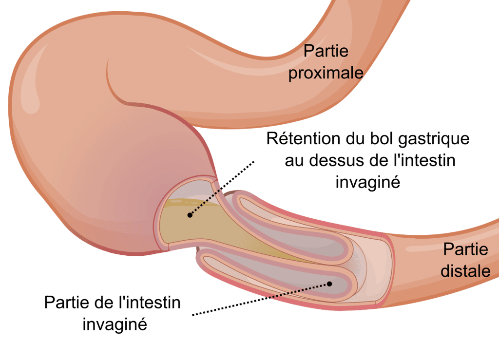 Schéma d'une invagination intestinale : une partie de l'intestin se replie en doigt de gant dans la zone sous-jacente. © Orem, CC by-sa 3.0