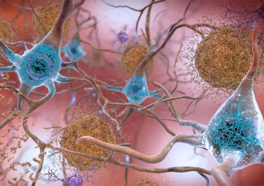 Dans la maladie d’Alzheimer, deux phénomènes pathologiques cérébraux ont déjà bien été documentés : l’accumulation de peptides bêta-amyloïdes et la modification de Tau, une protéine, qui se retrouve sous la forme d’agrégats dans les neurones. © NIH, domaine public 