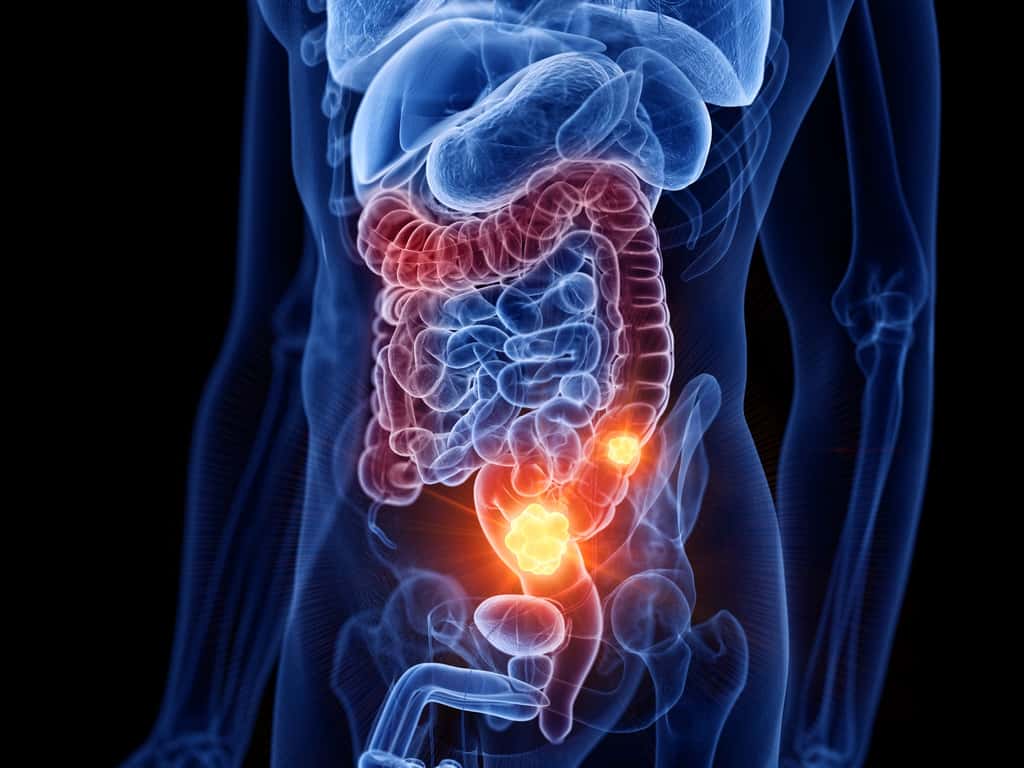 Le cancer du côlon est l'un des plus meurtriers en France. Ils affectent le plus souvent les personnes de plus de 50 ans, mais peut également survenir chez des personnes plus jeunes. © Sebastian Kaulitzki