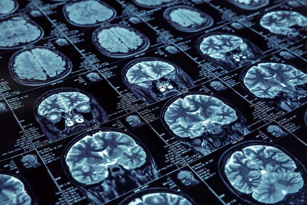 Dans le cerveau de patients souffrant d’Alzheimer, on observe des plaques séniles correspondant à l’accumulation d’amyloïde. © Nomad_Soul, Fotolia