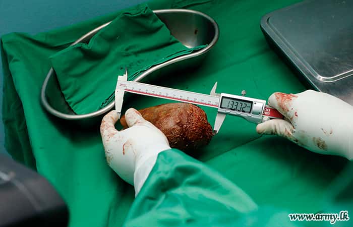 Chez ce patient sri lankais, le calcul rénal mesurait plus de 13 centimètres. © Armée du Sri Lanka