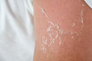 La peau qui pèle est le premier niveau de gravité d'un coup de soleil. © Ilja, Adobe Stock