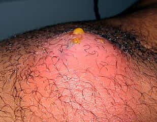 Abcès suite à une piqure: on note une tuméfaction inflammatoire et écoulement de pus© Grook Da Oger, Wikimedia commons CC BY-SA 4.0 