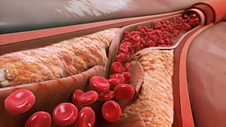 Le « mauvais » cholestérol favorise les plaques d'athéromes dans les artères. © Manu5, CC by-sa 4.0, Wikimedia Commons