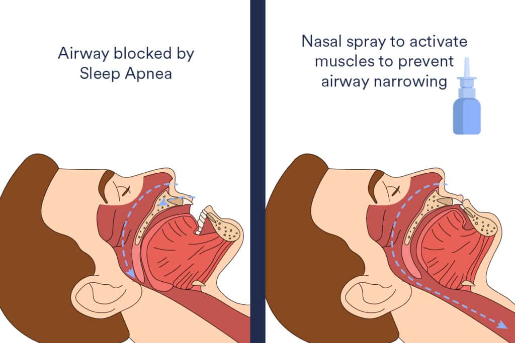 L'utilisation d'un spray nasal au coucher qui active les muscles de la gorge peut réduire la gravité de l'apnée du sommeil et abaisser la tension artérielle. © <em>Flinders University</em>