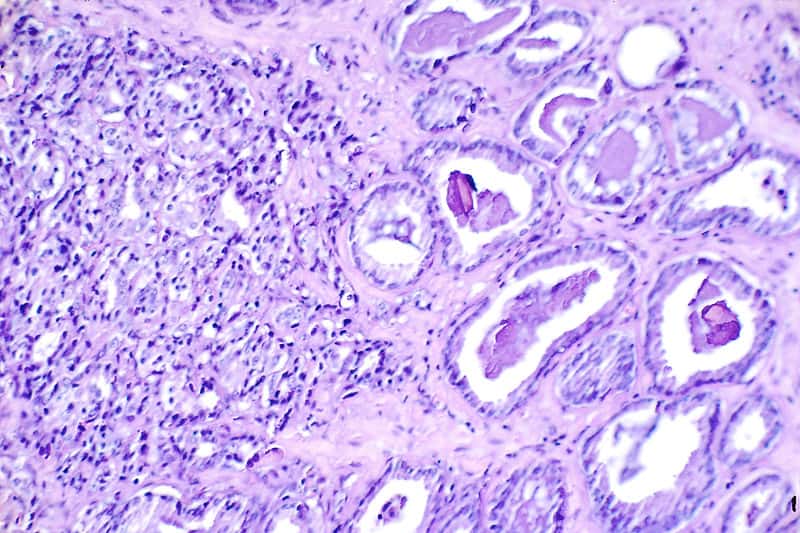 Coupe histologique de cancer de la prostate, avec des tissus dédifférenciés. Certains longs ARN non codants semblent spécifiques de cellules du cancer de la prostate. © Otis Brawley, NIH, DP